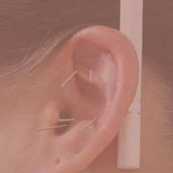 Akupunktur Haderslev, øre med nåle i